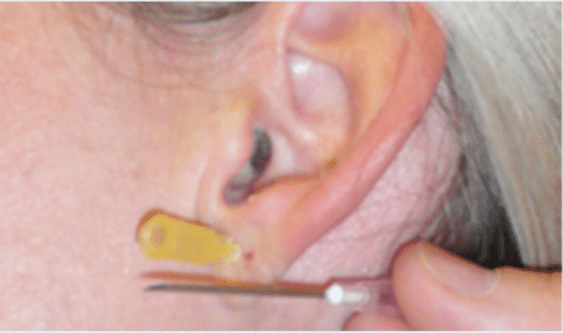 After Image: Earlobe Repair - front