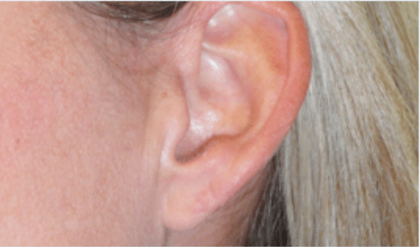 After Image: Earlobe Repair - left-side