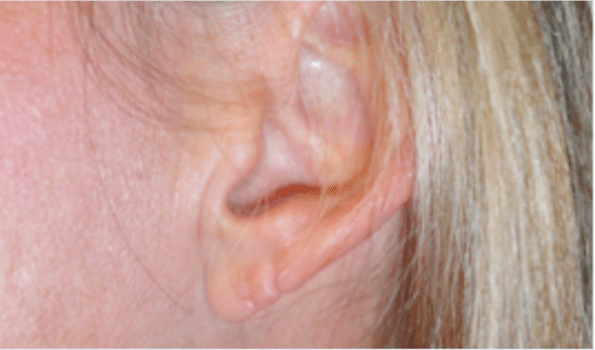 Before Image: Earlobe Repair - front