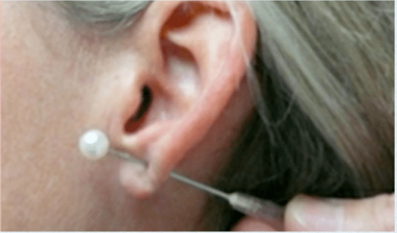 Before Image: Earlobe Repair - left-side