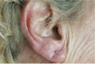 After Image: Earlobe Repair - right-side