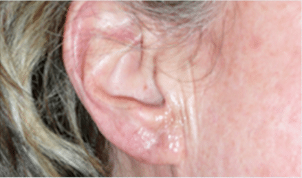 After Image: Earlobe Repair - front