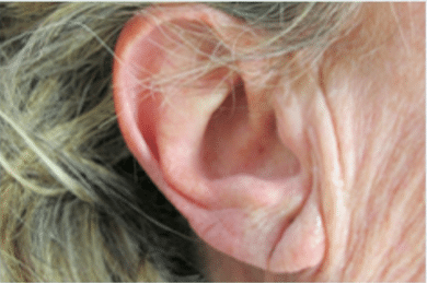 Before Image: Earlobe Repair - right-side