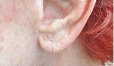 After Image: Earlobe Repair - left-side