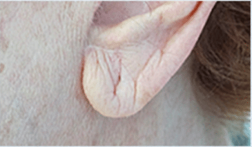 Before Image: Earlobe Repair - left-side