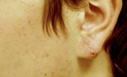 After Image: Earlobe Repair - front