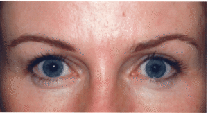 After Image: Eyelid Surgery