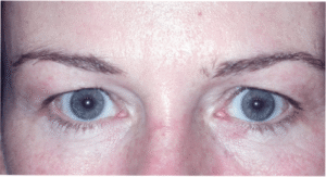 Before Image: Eyelid Surgery
