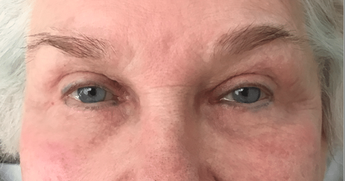 After Image: Eyelid Surgery - front