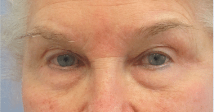 Before Image: Eyelid Surgery - front