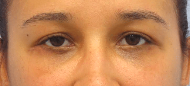 After Image: Eyelid Surgery - front