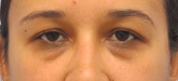 Before Image: Eyelid Surgery - front