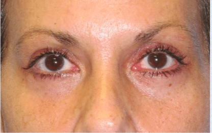 After Image: Eyelid Surgery - front