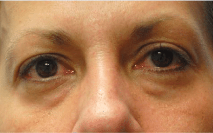 Before Image: Eyelid Surgery - front