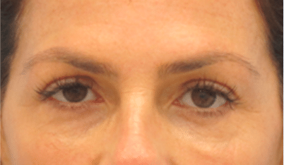 After Image: Eyelid Surgery - front