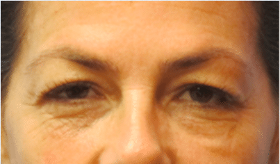Before Image: Eyelid Surgery - front