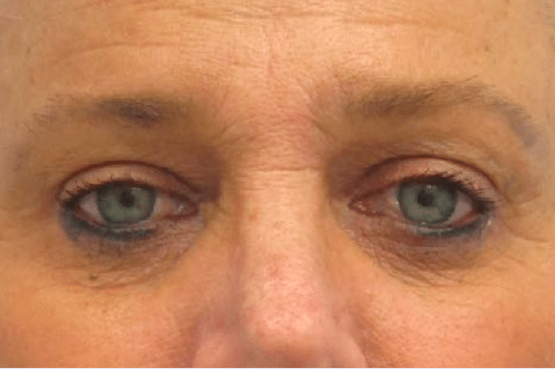 After Image: Eyelid Surgery - front