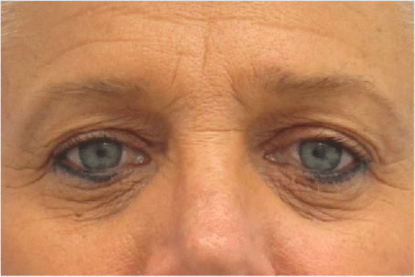 Before Image: Eyelid Surgery - front