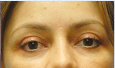 After Image: Eyelid Surgery - front