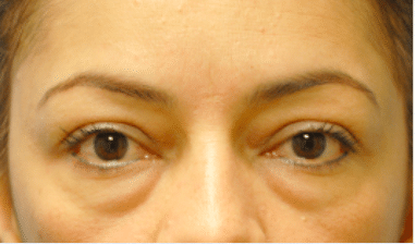 Before Image: Eyelid Surgery - front