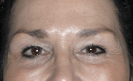 After Image: Eyelid Surgery - front