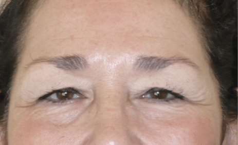 Before Image: Eyelid Surgery - front