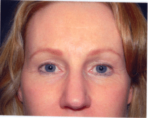 After Image: Eyelid Surgery