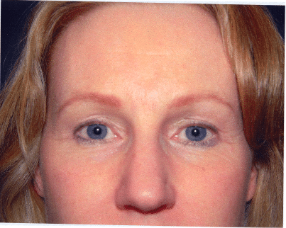 After Image: Eyelid Surgery - front