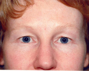 Before Image: Eyelid Surgery