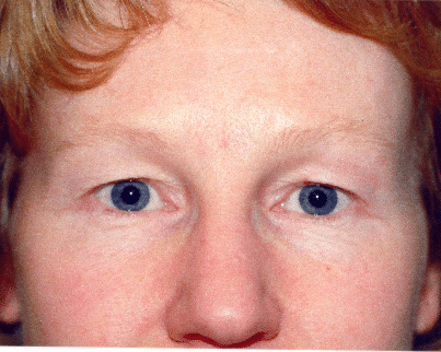 Before Image: Eyelid Surgery - front