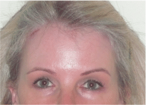 After Image: Eyelid Surgery