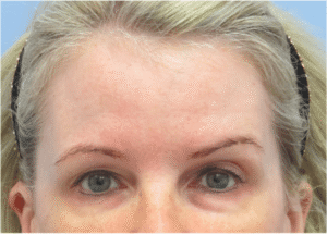 Before Image: Eyelid Surgery