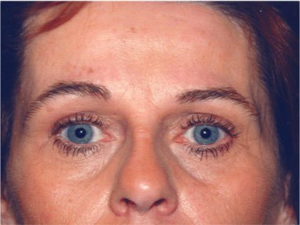 After Image: Eyelid Surgery - front