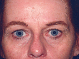 Before Image: Eyelid Surgery