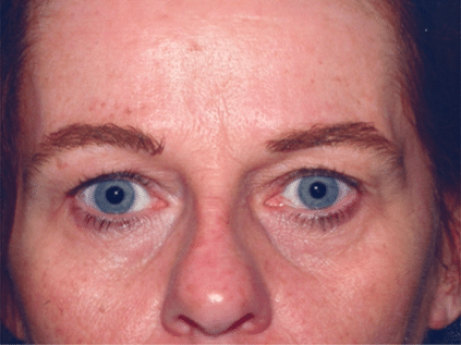 Before Image: Eyelid Surgery - front