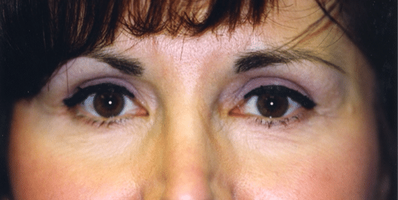 After Image: Eyelid Surgery - front