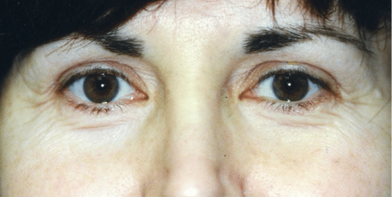 Before Image: Eyelid Surgery - front
