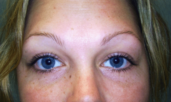 After Image: Eyelid Surgery - front