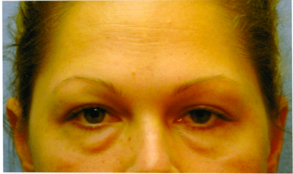 Before Image: Eyelid Surgery - front