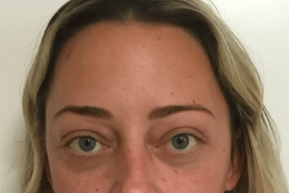 After Image: Eyelid Surgery - front