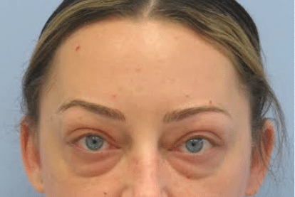 Before Image: Eyelid Surgery - front