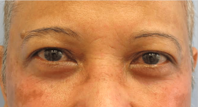After Image: Eyelid Surgery - front