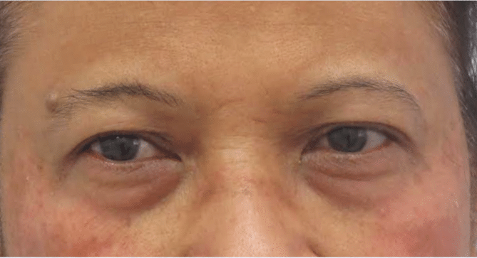 Before Image: Eyelid Surgery - front