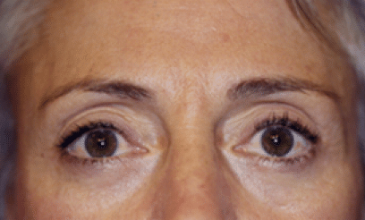 After Image: Eyelid Surgery - front