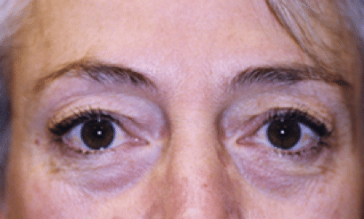 Before Image: Eyelid Surgery - front