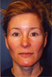 After Image: Facelift