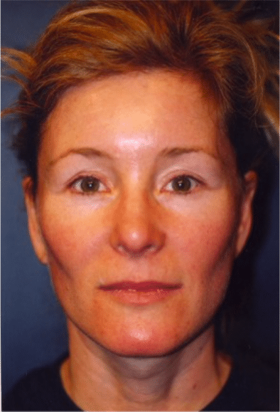 After Image: Facelift - front