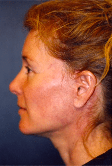 After Image: Facelift - left-side