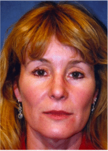 Before Image: Facelift