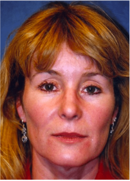 Before Image: Facelift - front